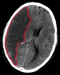 CT scan van een herseninfarct