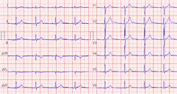 ecg