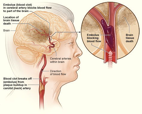 herseninfarct