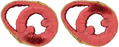 anterior en posterior infarct